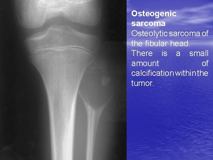 Osteogenic sarcoma Osteolytic sarcoma of the fibular head. There is a small amount of
