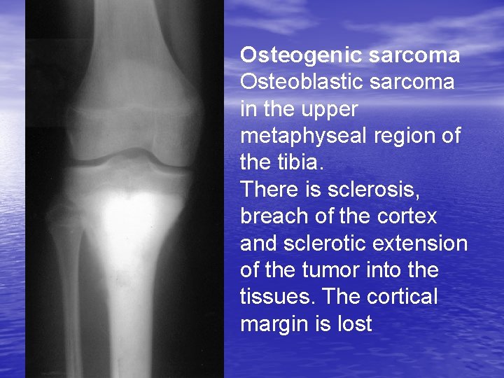 Osteogenic sarcoma Osteoblastic sarcoma in the upper metaphyseal region of the tibia. There is