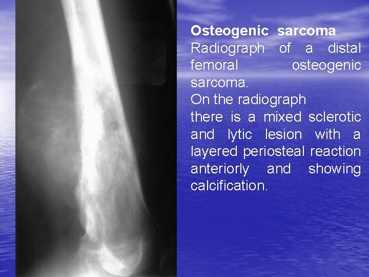 Osteogenic sarcoma Radiograph of a distal femoral osteogenic sarcoma. On the radiograph there is