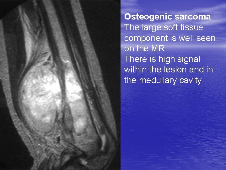 Osteogenic sarcoma The large soft tissue component is well seen on the MR. There