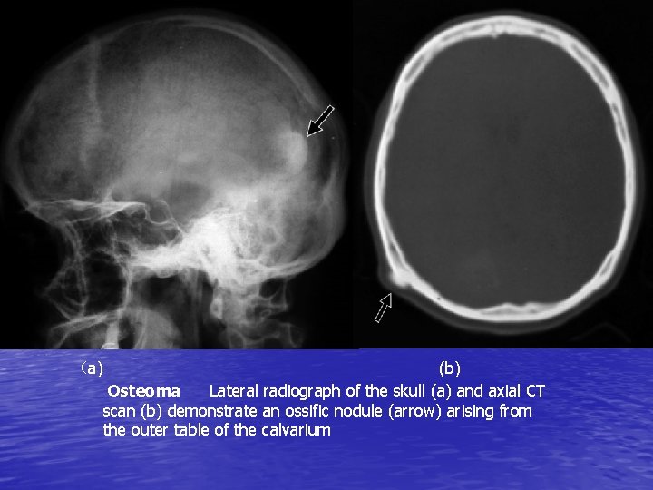 （a) (b) Osteoma Lateral radiograph of the skull (a) and axial CT scan (b)