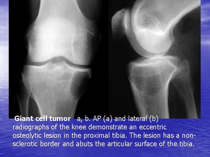 Giant cell tumor a, b. AP (a) and lateral (b) radiographs of the knee