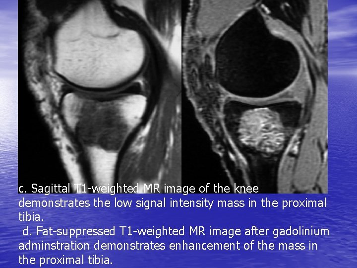 c. Sagittal T 1 -weighted MR image of the knee demonstrates the low signal