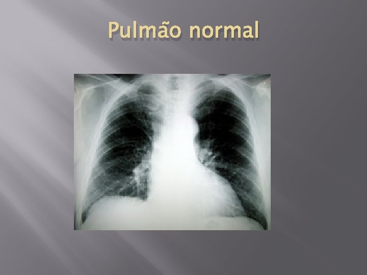 Pulmão normal 
