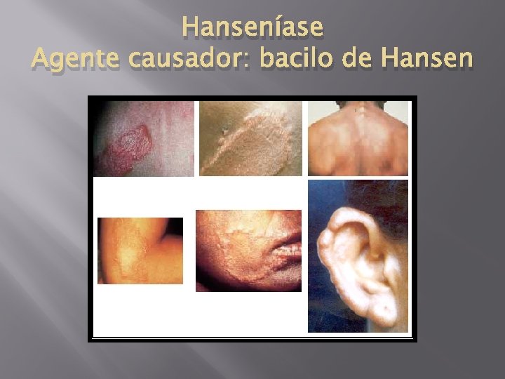 Hanseníase Agente causador: bacilo de Hansen 