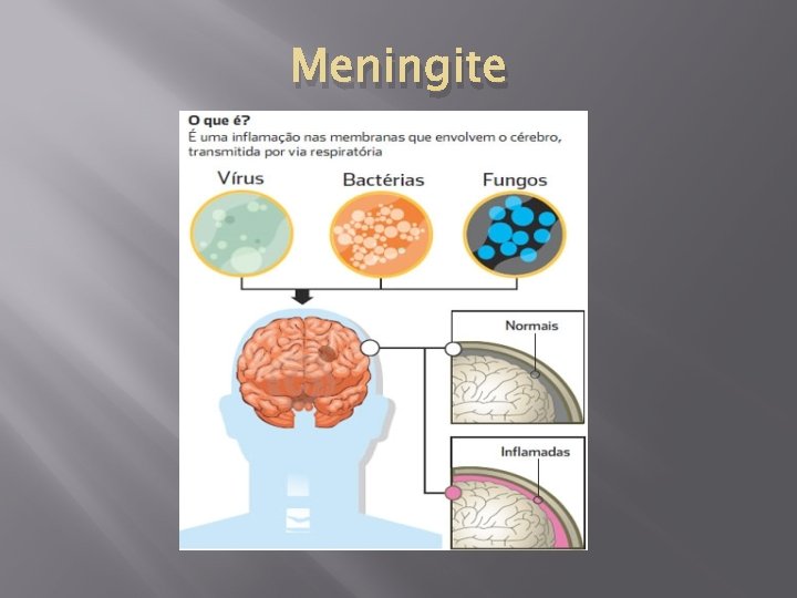 Meningite 