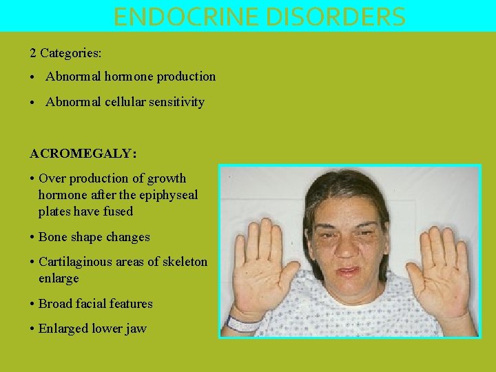 ENDOCRINE DISORDERS 2 Categories: • Abnormal hormone production • Abnormal cellular sensitivity ACROMEGALY: •