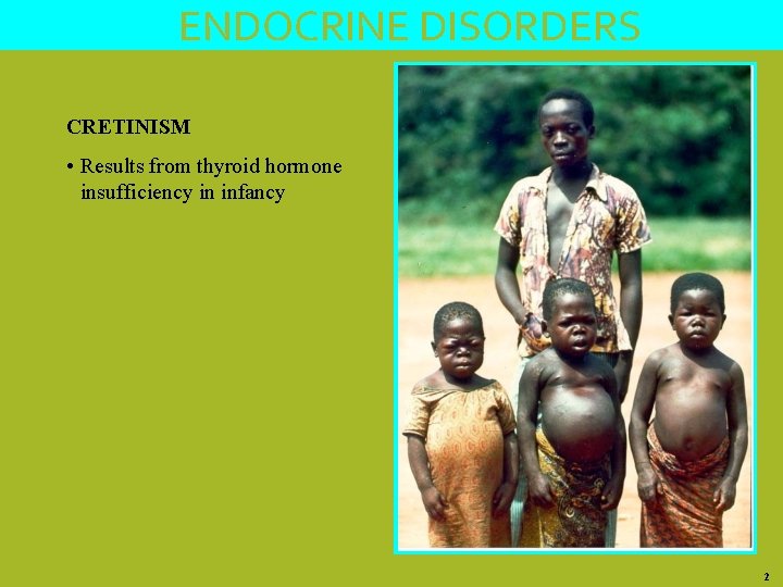 ENDOCRINE DISORDERS CRETINISM • Results from thyroid hormone insufficiency in infancy 2 