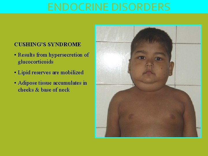 ENDOCRINE DISORDERS CUSHING’S SYNDROME • Results from hypersecretion of glucocorticoids • Lipid reserves are