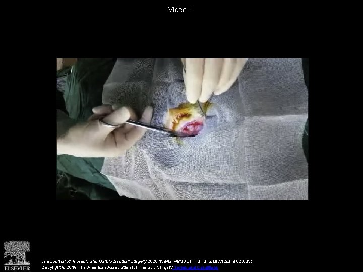 Video 1 The Journal of Thoracic and Cardiovascular Surgery 2020 159461 -473 DOI: (10.