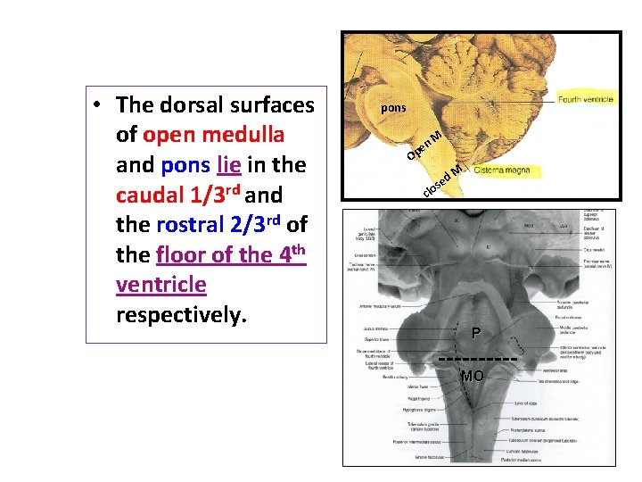  • The dorsal surfaces of open medulla and pons lie in the caudal