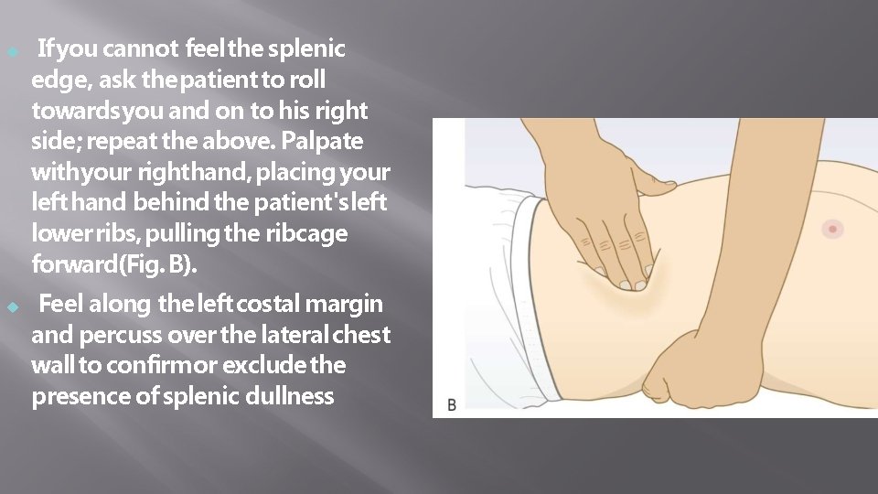  If you cannot feel the splenic edge, ask the patient to roll towards