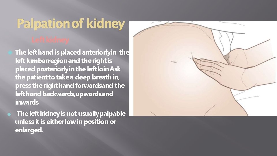 Palpation of kidney Left kidney The left hand is placed anteriorlyin the left lumbarregion