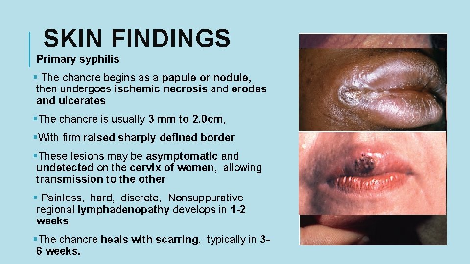 SKIN FINDINGS Primary syphilis § The chancre begins as a papule or nodule, then