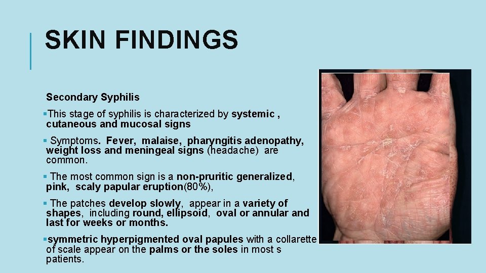 SKIN FINDINGS Secondary Syphilis §This stage of syphilis is characterized by systemic , cutaneous
