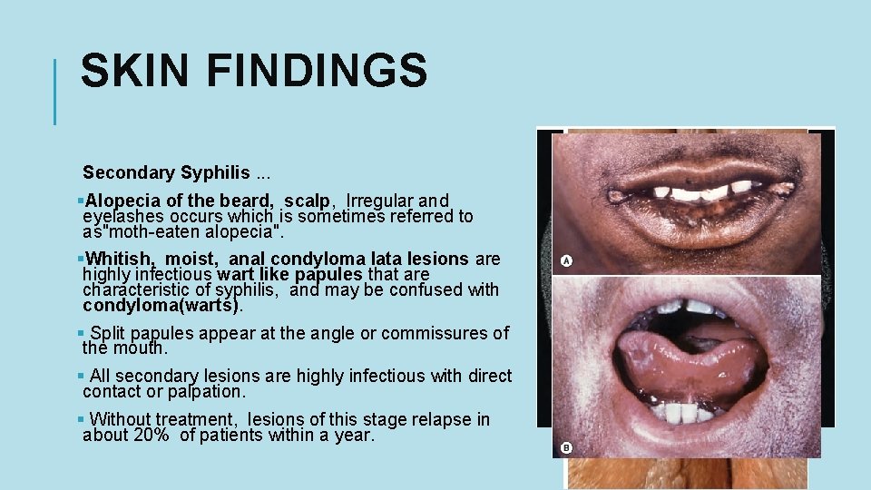 SKIN FINDINGS Secondary Syphilis. . . §Alopecia of the beard, scalp, Irregular and eyelashes