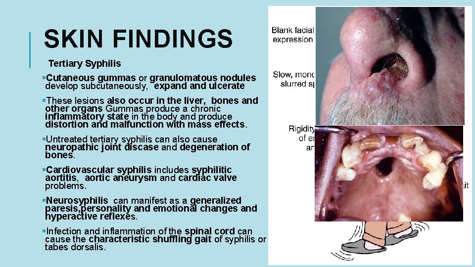 SKIN FINDINGS Tertiary Syphilis §Cutaneous gummas or granulomatous nodules develop subcutaneously, expand ulcerate §These