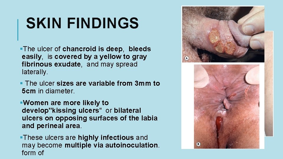 SKIN FINDINGS §The ulcer of chancroid is deep, bleeds easily, is covered by a