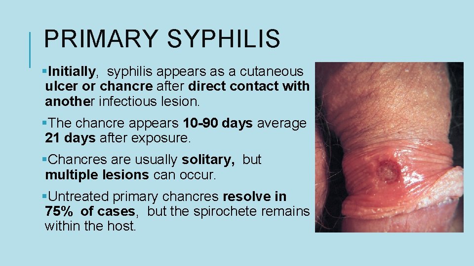 PRIMARY SYPHILIS §Initially, syphilis appears as a cutaneous ulcer or chancre after direct contact