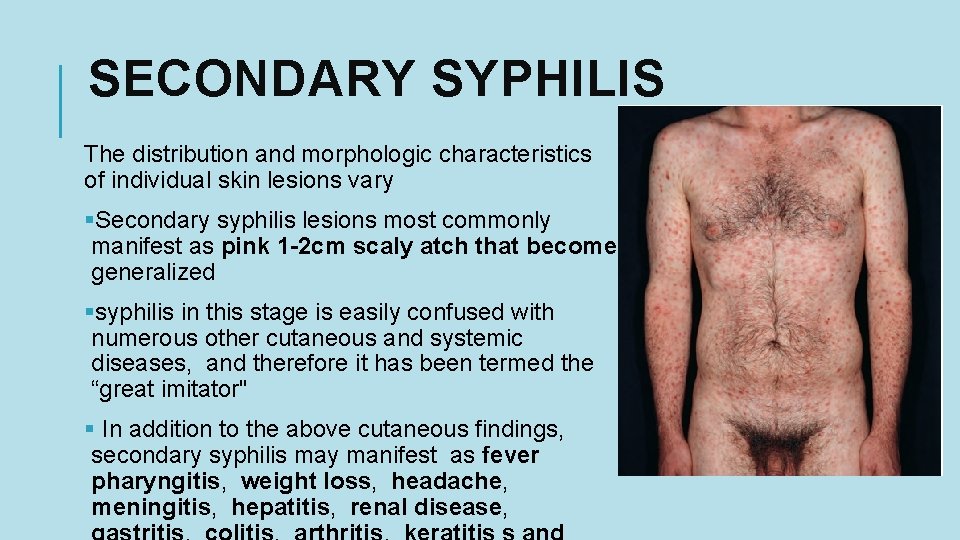 SECONDARY SYPHILIS The distribution and morphologic characteristics of individual skin lesions vary §Secondary syphilis