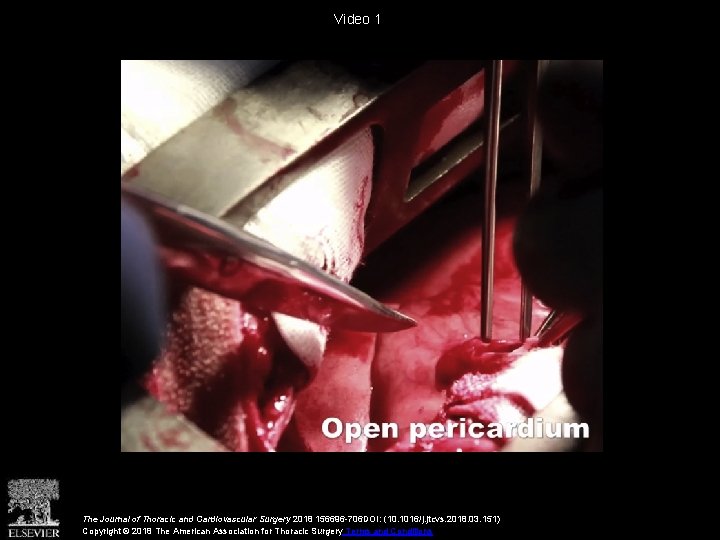 Video 1 The Journal of Thoracic and Cardiovascular Surgery 2018 156696 -706 DOI: (10.