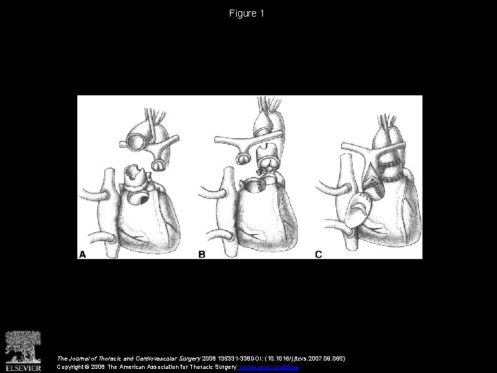 Figure 1 The Journal of Thoracic and Cardiovascular Surgery 2008 135331 -338 DOI: (10.