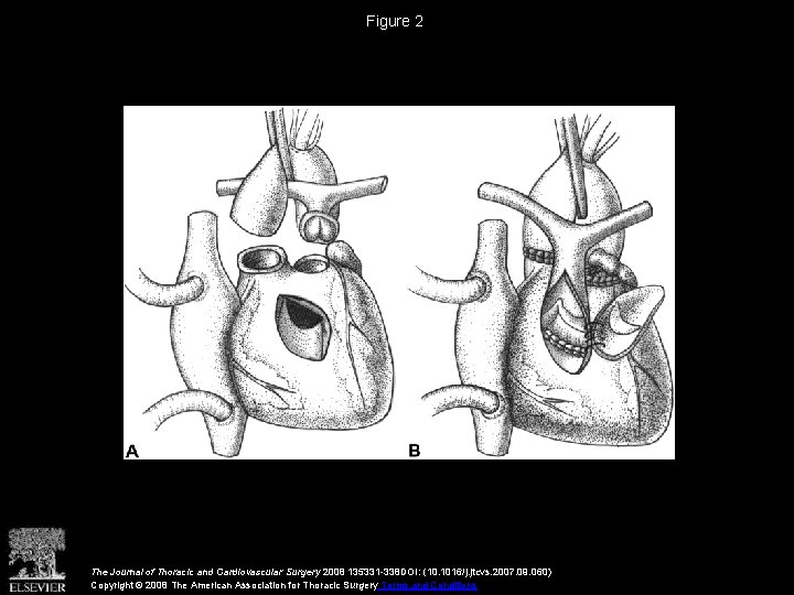 Figure 2 The Journal of Thoracic and Cardiovascular Surgery 2008 135331 -338 DOI: (10.