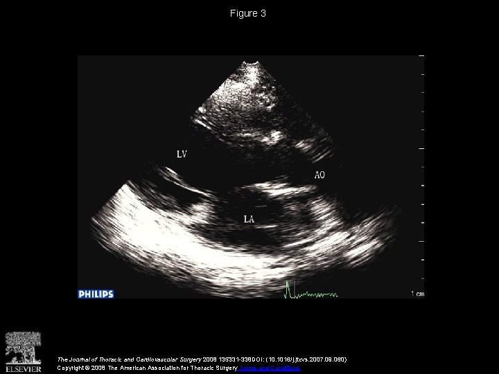 Figure 3 The Journal of Thoracic and Cardiovascular Surgery 2008 135331 -338 DOI: (10.