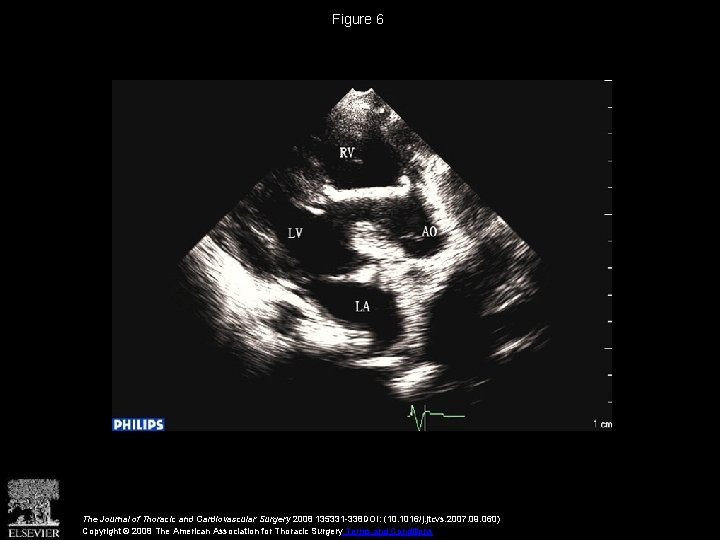 Figure 6 The Journal of Thoracic and Cardiovascular Surgery 2008 135331 -338 DOI: (10.