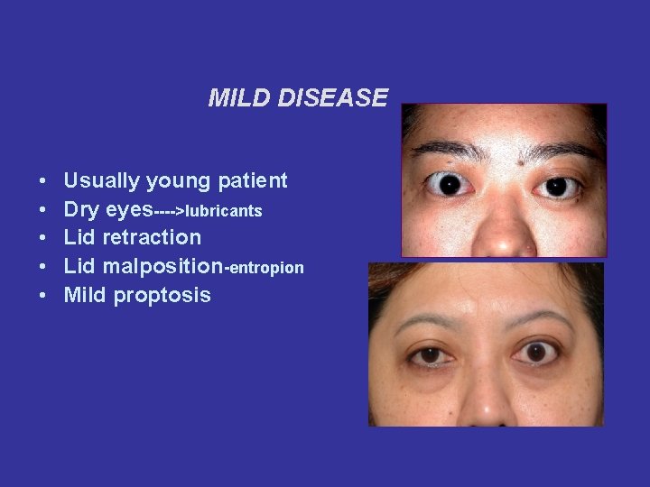 MILD DISEASE • • • Usually young patient Dry eyes---->lubricants Lid retraction Lid malposition-entropion