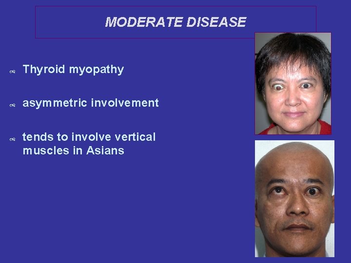 MODERATE DISEASE Thyroid myopathy asymmetric involvement tends to involve vertical muscles in Asians 