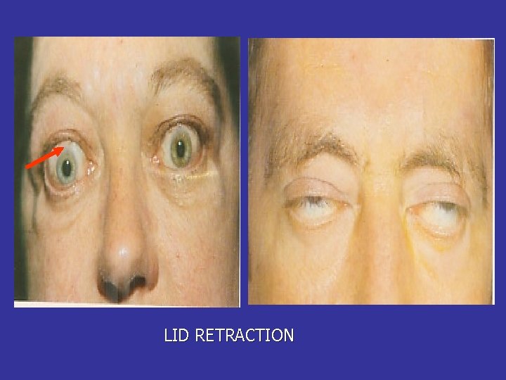 LID RETRACTION 