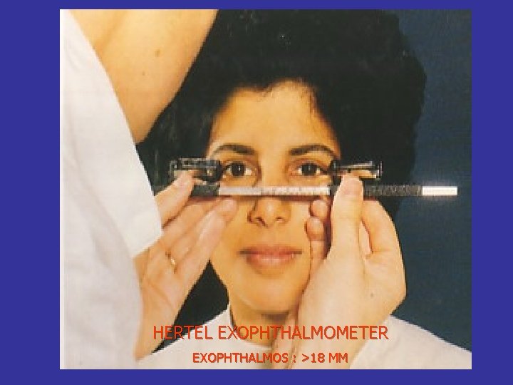 HERTEL EXOPHTHALMOMETER EXOPHTHALMOS : >18 MM 
