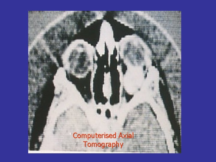 Computerised Axial Tomography 