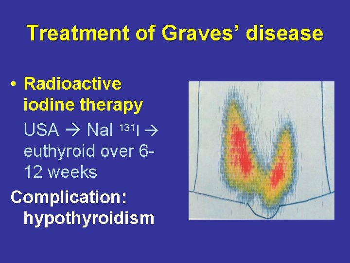 Treatment of Graves’ disease • Radioactive iodine therapy USA Na. I 131 I euthyroid