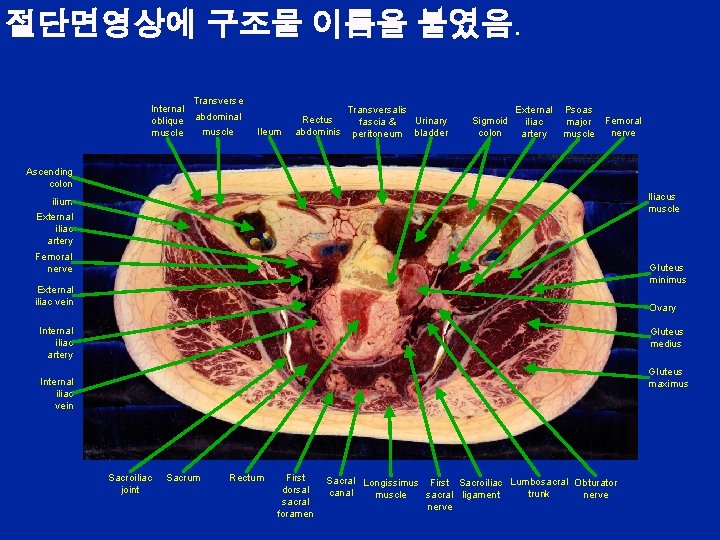 절단면영상에 구조물 이름을 붙였음. Internal oblique muscle Transverse abdominal muscle Ileum Rectus abdominis Transversalis
