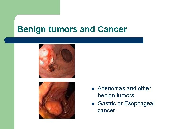 Benign tumors and Cancer l l Adenomas and other benign tumors Gastric or Esophageal