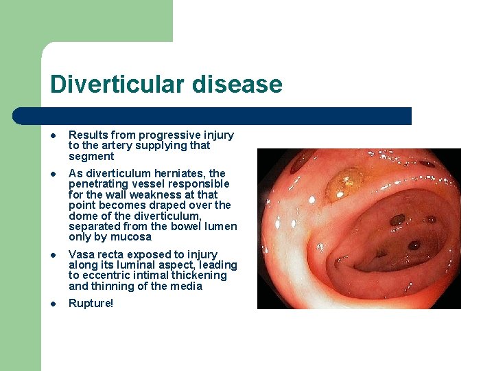 Diverticular disease l Results from progressive injury to the artery supplying that segment l