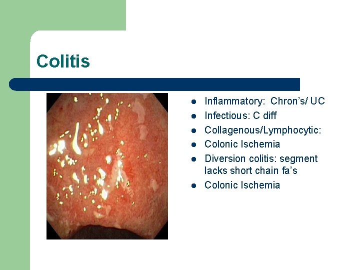 Colitis l l l Inflammatory: Chron’s/ UC Infectious: C diff Collagenous/Lymphocytic: Colonic Ischemia Diversion
