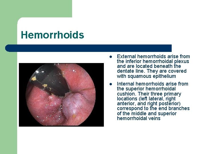 Hemorrhoids l External hemorrhoids arise from the inferior hemorrhoidal plexus and are located beneath