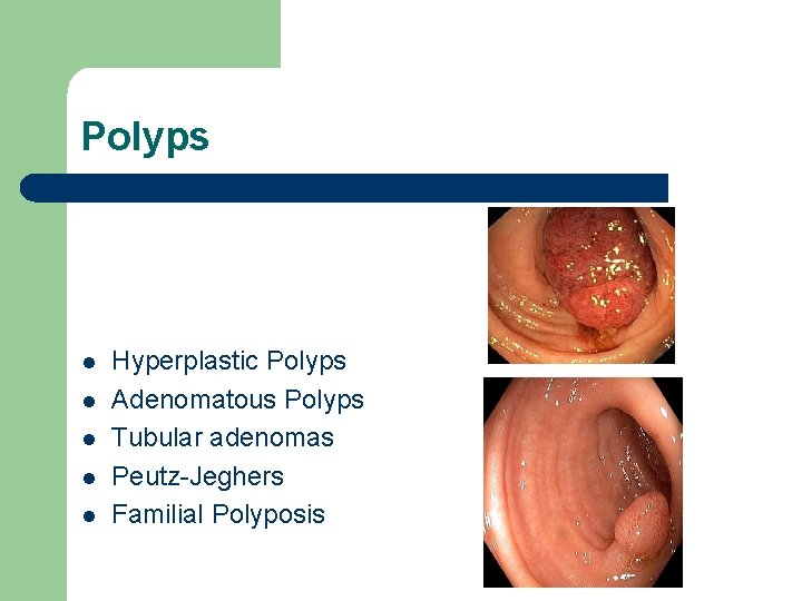 Polyps l l l Hyperplastic Polyps Adenomatous Polyps Tubular adenomas Peutz-Jeghers Familial Polyposis 