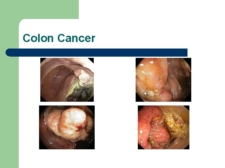 Colon Cancer 