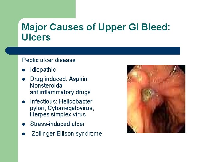 Major Causes of Upper GI Bleed: Ulcers Peptic ulcer disease l Idiopathic l Drug