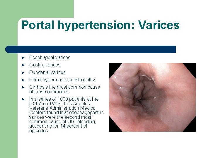 Portal hypertension: Varices l Esophageal varices l Gastric varices l Duodenal varices l Portal