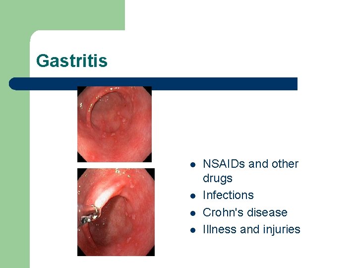 Gastritis l l NSAIDs and other drugs Infections Crohn's disease Illness and injuries 