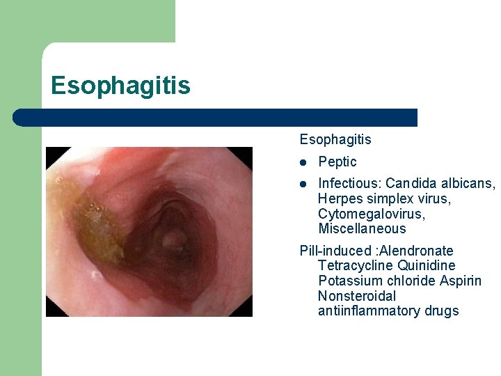 Esophagitis l Peptic l Infectious: Candida albicans, Herpes simplex virus, Cytomegalovirus, Miscellaneous Pill-induced :