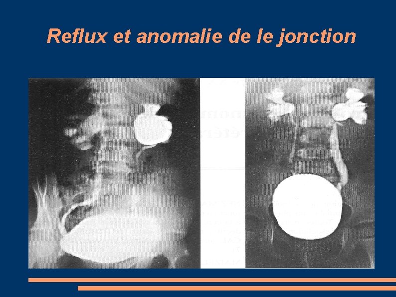 Reflux et anomalie de le jonction 