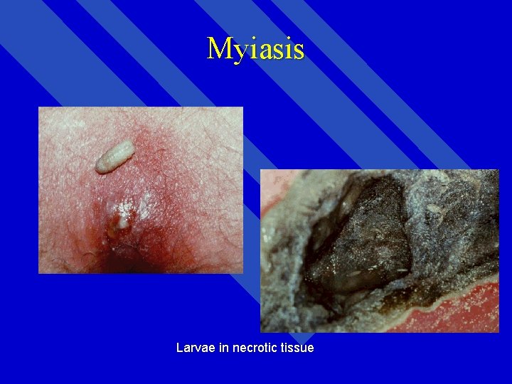 Myiasis Larvae in necrotic tissue 