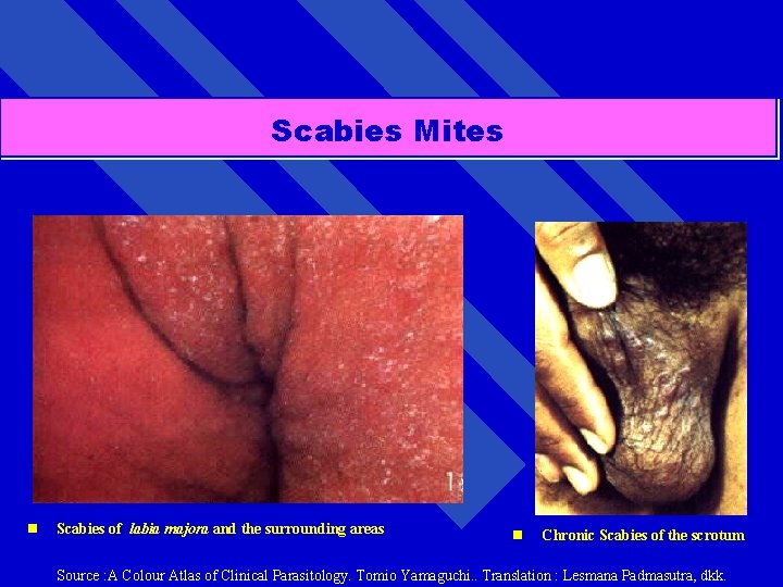 Scabies Mites n Scabies of labia majora and the surrounding areas n Chronic Scabies