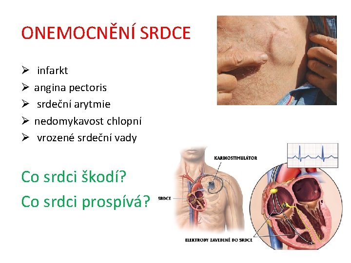 ONEMOCNĚNÍ SRDCE Ø Ø Ø infarkt angina pectoris srdeční arytmie nedomykavost chlopní vrozené srdeční